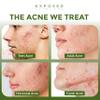Exposed Skin Care, Acne Treatment Serum with 3.5% Benzoyl Peroxide  Lightweight Acne Spot Treatment  Quickly Clear Teen, Adult, Hormonal and Cystic Acne  Natural, Non-toxic and Cruelty Free view 2