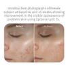 Epionce Lytic Tx Facial Retexturizing Lotion - Oil, Blemish, Pore Minimizer view 4