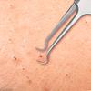 Beaute Galleria Premium Stainless Steel Bend Curved Blemish Extractor Tool for Remove Comedones Whitehead Blackhead Acne Pimple view 3