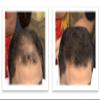 Caboki Hair Loss Concealer, 90-day supply, Dark Brown view 4