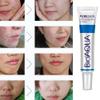 BioAqua Face Skin Care Acne Treatment Removal Scar Blemish Marks Cream view 4