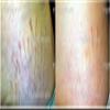 Best Stretch Mark Microdermabrasion Crystals- Most Effective treatment for Old White Stretch Marks pure Stretch Mark Microdermabrasion Medical Crystals for manual use 2lbs shown to remove dead skin cells, exfoliate rough skin,repair scars and old whi view 4
