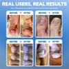 CurveCorrect Ingrown Toenail Treatment Kit - Ingrown Toenail Corrector Kit with 10 Braces - at Home Ingrown Toenail Correction - Big Toe Ingrown Nail Removal view 3