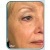 Biologic Stem Cell Wrinkle Therapy - (Set of 2) view 3