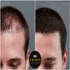 CROWN Hair Building Fibers (28g) - Instantly Cover Fine & Thinning Hair for a Thicker, Fuller Look - A Natural Keratin Concealer - 13 Shades for Men & Women - Dark Brown view 3