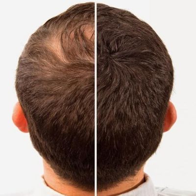 Hair Building Fibers- A-Lister REFILL Pak for Toppik, Nanogen, Xfusion, any Brand (25g, Light Brown)