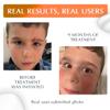 MyNewGel Plus UV Advanced Silicone Scar Gel | Old & New Scars | SPF30 Mineral non-chemical Sunscreen | Ideal for Protecting Scars | Harmful Ultraviolet Rays, 15g (0.5 oz) view 3