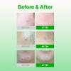 Acropass Trouble Care Microcone Acne Patch for Early Stage Pimple and Zits - Hydrocolloid, Niacimide Pimple Spot Treatment (Regular Size - 6count) view 3