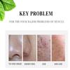 AICHUN BEAUTY Face Acne Cleaning Cream Skin Care Remove Repair Comedone Pimple Acne Face Acne Cream 30ml/1.0fl.oz view 3
