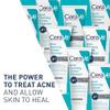 CeraVe Acne Foaming Cream Cleanser, 4% Benzoyl Peroxide Face Wash With Hyaluronic Acid, Niacinamide & Ceramides, Gentle Daily Acne Treatment For Face view 2