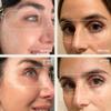 Dermaclara Silicone Patch Eyes & Forehead Kit - Anti-Wrinkle Face Patches for Frown & Smile Lines, Reusable Overnight Silicone Wrinkle Pads, Up to 30 Uses - 4 Eye & Mouth, 1 Forehead view 3