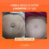 Cicatrissim Stretch Mark Cream for Red and White Striae - Softens Stretch Marks, Evens Skin Tone, and Firms Skin - All Skin Types - 150g view 3