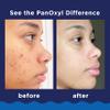 PanOxyl Acne Foaming Wash Benzoyl Peroxide 10% Maximum Strength Antimicrobial, 5.5 Ounce (Pack of 1) view 4