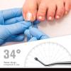 FERYES Ingrown Toenail Tools,Toenail Lifter and Toenail File Set for Ingrown Toenails Treatment - Surgical Grade Stainless Steel Under Nail Cleaner Pedicure Tools - W/Tin Storage Box view 2