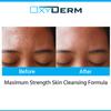 Acne Face wash Treatment with Benzoyl Peroxide 5% - Clinically Proven Wash to Fight Acne Blemishes on Contact. Eliminates Cystic Breakouts, Oily Skin, Clogged Pores, Blackhead, Whitehead, & Pimples. view 3