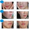 BIOAQUA 3in1 Face Anti Acne Set Scar Removal Spots Pimples Oil Cream Foam Scar Blemish Marks Moisturizing Oil 100g+30g+30ml view 2