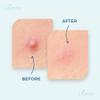 CLAENE Acne Patch Pimple Patch - Invisible | Cruelty-Free | Hydrocolloid | Blemish Spot | Facial Stickers | Acne Spot Dots | Pimple Free, For Face (112 Count (Pack of 1)) view 4