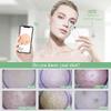 Blackhead Remover Pore Vacuum, [FDA Certification]  WiFi Visible Facial Pore Cleanser with HD Camera Pimple Acne Comedone Extractor Kit with 6 Suction Heads Electric Blackhead Suction Tool view 2