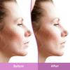Differin Gel Acne Scar Spot Treatment for Face, Resurfacing Scar Gel, Gentle Skin Care for Acne Prone Sensitive Skin, 1 Oz (Packaging May Vary) view 4