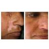 Melgain Lotion for Vitiligo/White Patches: Decapeptide : Stimulates Pigmentation 10ml (Pack OF 2) - With Express Shipping view 3