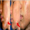 Melgain Lotion for Vitiligo/White Patches: Decapeptide : Stimulates Pigmentation 10ml (Pack OF 2) - With Express Shipping view 4