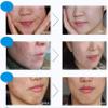 BIOAQUA 4-in-1 Face Care Set, Acne Scar & Blemish Removal Cream, Foam Cleanser 100g, Face Mask 4pcs, Essence Oil 30ml, Acne Cream 30g, Moisturizing & Spot Treatment view 2