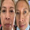 Pro Home Peels Professional Face Chemical Peel for Hyperpigmentation and Dark Spots view 3