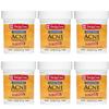 De La Cruz Sulfur Ointment - Cystic Acne Treatment for Face and Body - Daily 10 Min Spot Treatment Mask - Safe and Effective Game Changing Hormonal Acne Treatment that Clears Up Pimples 2.6oz (6 Pack) view 1