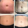 Dermaclara Silicone Patch Stretch Mark Kit - Pregnancy Stretch Mark Prevention, C Section Cover Up Belly Scar, Maternity Skincare, Silicone Gel Sheet, Reusable up to 30 Times - 2 Patches & 1 Cleanser view 3