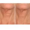 SiO Beauty NeckLift - Neckline Anti-Wrinkle Patch - Overnight Smoothing Silicone Patches For Neck Wrinkles, Fine Lines And Turkey Neck view 2