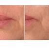 SiO Beauty Super LipLift - Smile & Lip Anti-Wrinkle Patches 4 Week Supply - Overnight Smoothing Silicone Patches For Lip & Smile Wrinkles And Fine Lines view 2