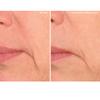 SiO Beauty Super LipLift - Smile & Lip Anti-Wrinkle Patches 4 Week Supply - Overnight Smoothing Silicone Patches For Lip & Smile Wrinkles And Fine Lines view 3