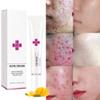 Acne Cream Pimple Cream for Face, Oil Control Pimple Remover Cream Get Rid of Pimples Fast,for Oily and Acne Prone Skin, Cruelty Free, Crema para espinillas en la cara view 2
