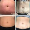 Dermaclara Large Silicone Body Patch - Pregnancy Stretch Mark Prevention, C Section Cover Up Belly Scar Sheet, Maternity Skincare, Mom to Be Silicone Gel Sheet, Reusable up to 30 Times - 1 Patch view 3