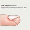 Depslee Ingrown Toenail Corrector Strips, Silicone Nail Pads Kit, painless toenail patch professional toenail treatment tool, improve the ingrown toenail (50 PIECE NAIL PADS SET) view 4