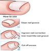 (50 +2) Pack Professional Ingrown Toenail Correction Treatment Kit, 50 Pcs Ingrown Toenail Corrector Straightener Strips Recover Clips with 2 Pcs Ingrown Toenail File And Lifter view 2