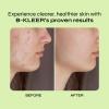 A-Cute Derm B-Kleer Cleansing Gel Acne Cleanser that Purify and Protect Your Skin from Clogged Pores for All Skin Types (4oz) view 4