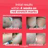 Cicatrissim Red Stretch Mark Cream for Red and Purple Striae - Softens Stretch Marks, Evens Skin Tone, and Firms Skin - All Skin Types - 150g view 3