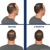 Bosley Revitalizer Flex 164 Diode 100% Laser No LEDs Hair Growth Cap (LLLT) Men and Women - Regrowth, Home Treatment, Thicker, Fuller, Healthy Hair, FDA Cleared. Large Size view 2