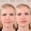 MESOLYFT Lip Plumper with Roller to Instantly Plump Lips, Promotes Hydration and Fullness, Plumping Lip Gloss for Fuller Lips, Serum to Moisturize Your Lips (12 ML) view 3