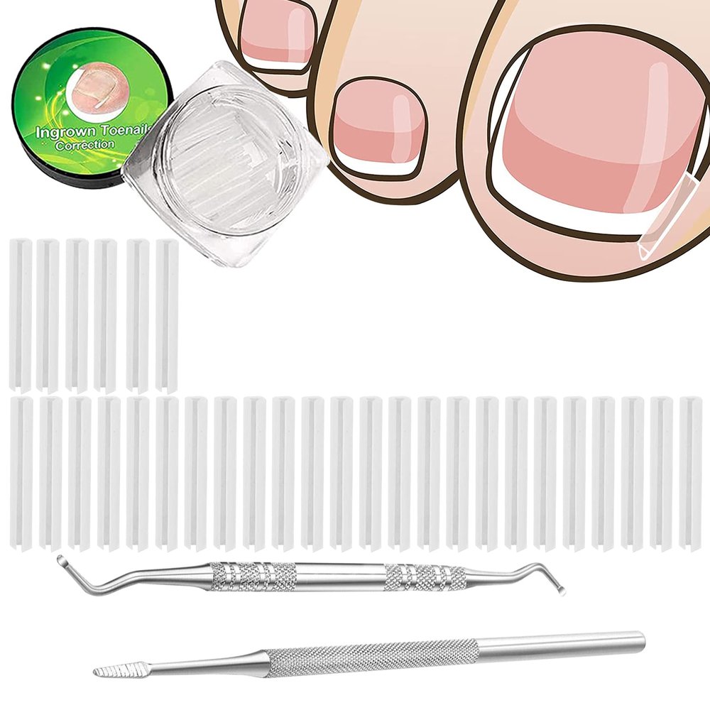 (30+2) Pack Ingrown Toenail Correction Treatment Kit, 30PCS Ingrown Toenails Corrector Strips Brace Ingrown Toenail Pedicure Tool Toenail Correction Patch with 2PCS Ingrown Toenails Lifter and File