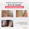 Cicatrissim White Stretch Mark Cream for White and Old Striae - Softens Stretch Marks, Evens Skin Tone, and Firms Skin - All Skin Types - 150g view 3
