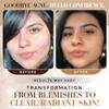 Noir D'or Acne Scar Treatment | Three-Step Extra Gentle Repair Set for Hyperpigmentation, Dark Spot Removal, and Breakouts | Face Skincare view 4