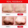 Dongng Blackhead Remover Vacuum, Acne Comedone Extractor Tool USB Rechargeable Pore Cleaner Electric Blackhead Suction Instrument with 3 Adjustable Suction Power and 3 Replacement Probes (White) view 4