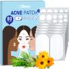 LitBear Large Acne Pimple Patches, 5 Sizes 80 Patches for Large Breakouts, Acne Patches for Face, Chin or Body, Acne Spot Patch with Tea Tree & Calendula Oil, Hydrocolloid Bandages for Acne Skin view 1