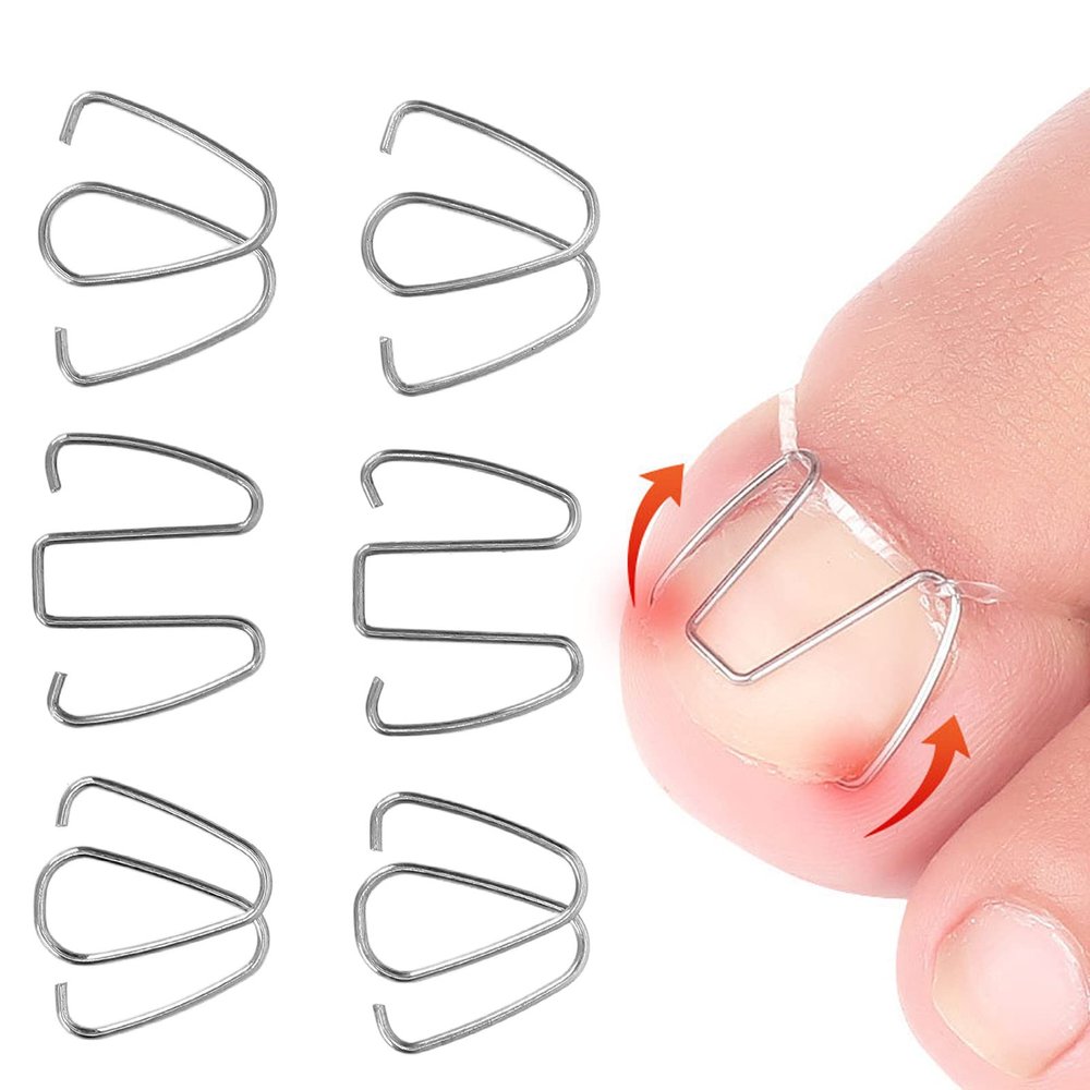 ZJchao Ingrown Toenail Corrector Tools, Nail Bunion Corrector Ingrown Toe Nail Wire Lifter Fixer Recover for Curved Toes & Swollen Cuticles