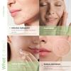 Artnaturals Acne Pimple Patches (144 Pack) Hydrocolloid Acne Patches with Tea Tree Treatment for Zits and Breakouts, Spots and Dots Stickers for Face and Skin view 3