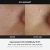 Medicube Age-R ATS Air Shot - Microneedling Pore Tightening Skin Care Device for Enhanced Absorption, Pore Refinement, and Smoother Skin Texture - Exfoliation, Skin Rejuvenation - Korean Skin Care view 3