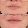 Mesolyft Neck & Lip Plumper Combo with Roller to Instantly Plump Lips & Neck - Neck Serum Improves the Neck Skin - Plumping Serum to Moisturize Your Lips and Neck view 3
