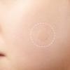 Stone Acne Pimple PatchHy drocolloid minimizes scar of wound indoor and outdoor unisex Blackhead Tool Extractor view 3